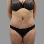 Tummy Tuck Before & After Patient #1621