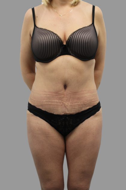 Tummy Tuck Before & After Patient #1621