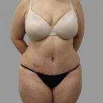 Tummy Tuck Before & After Patient #1582