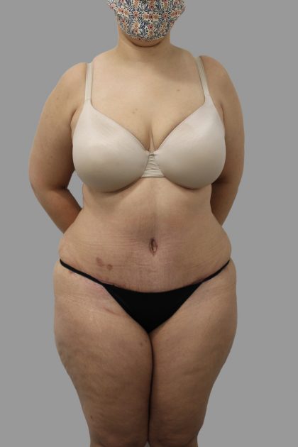 Tummy Tuck Before & After Patient #1582