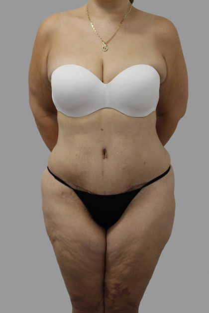 Tummy Tuck Before & After Patient #1658