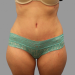 Tummy Tuck Before & After Patient #1585