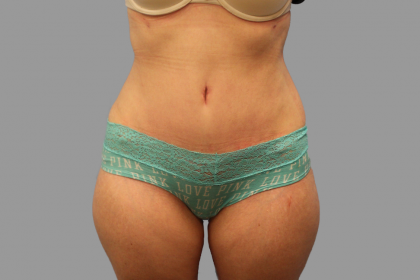 Tummy Tuck Before & After Patient #1585