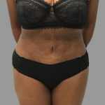 Tummy Tuck Before & After Patient #1588