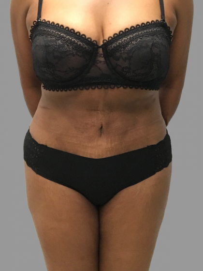 Tummy Tuck Before & After Patient #1588