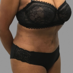 Tummy Tuck Before & After Patient #1588