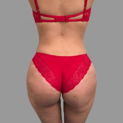 Brazilian Butt Lift Before & After Patient #1421