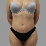 Tummy Tuck Before & After Patient #1624