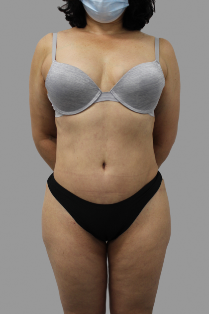 Tummy Tuck Before & After Patient #1624