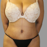 Tummy Tuck Before & After Patient #1627