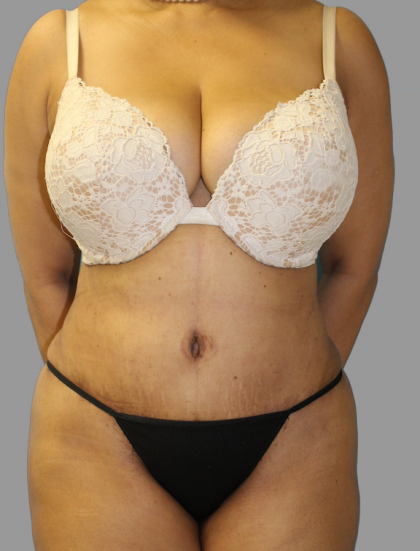 Tummy Tuck Before & After Patient #1627