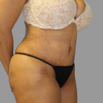 Tummy Tuck Before & After Patient #1627