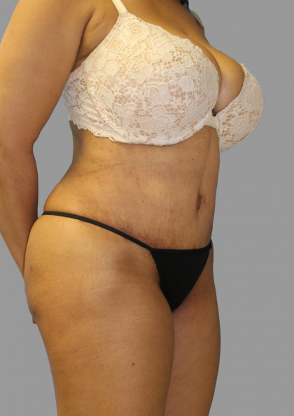 Tummy Tuck Before & After Patient #1627