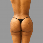 Brazilian Butt Lift Before & After Patient #1416