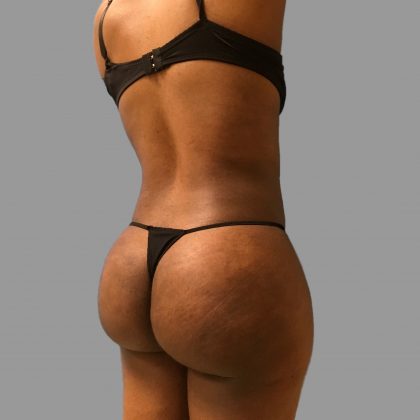 Brazilian Butt Lift Before & After Patient #1431