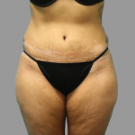 Tummy Tuck Before & After Patient #1638