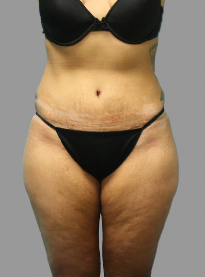 Tummy Tuck Before & After Patient #1638