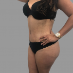 Tummy Tuck Before & After Patient #1641