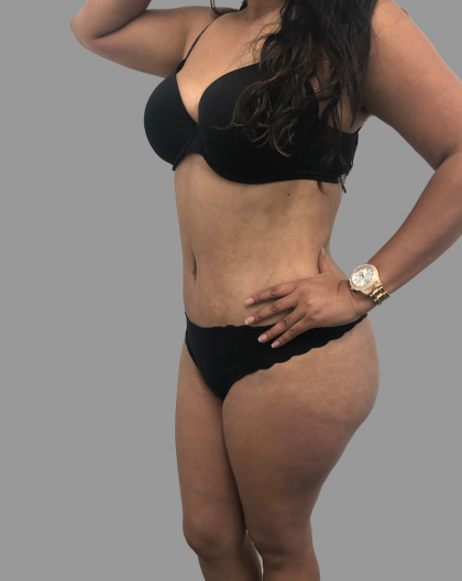 Tummy Tuck Before & After Patient #1641