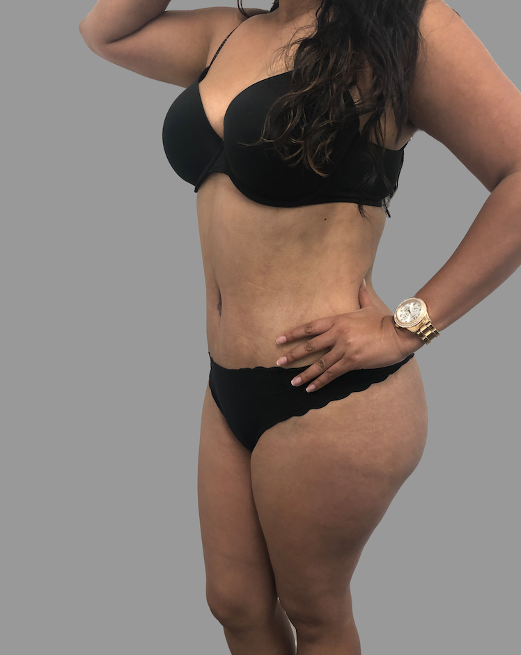 Tummy Tuck Before & After Patient #1641