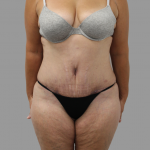 Tummy Tuck Before & After Patient #1655