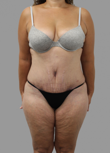 Tummy Tuck Before & After Patient #1655