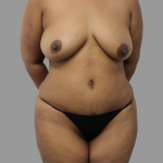 Tummy Tuck Before & After Patient #1661