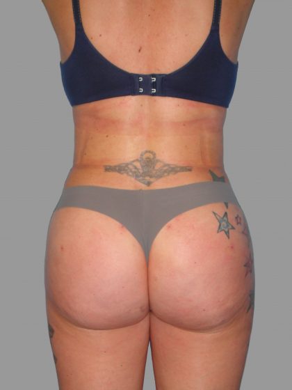 Brazilian Butt Lift Before & After Patient #1438