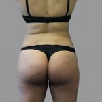 Brazilian Butt Lift Before & After Patient #1441