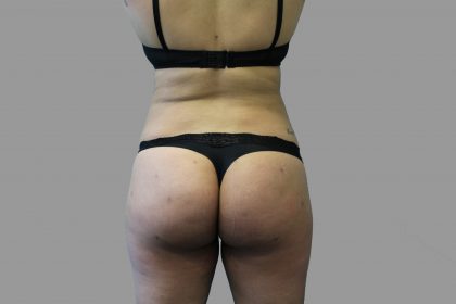 Brazilian Butt Lift Before & After Patient #1441
