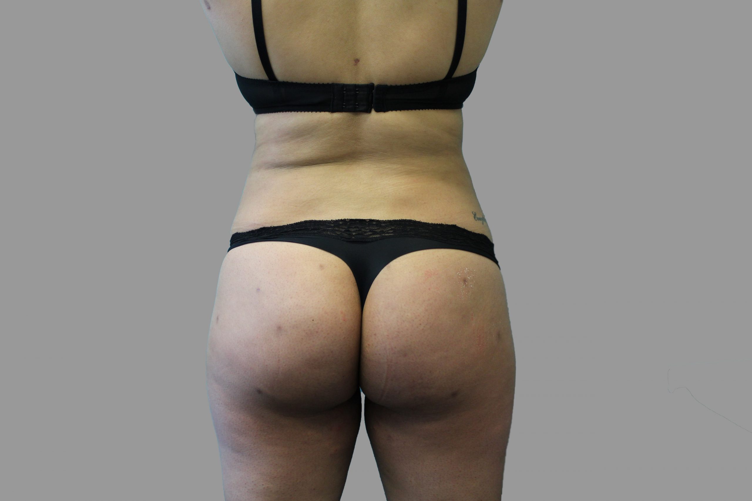 Brazilian Butt Lift Before & After Patient #1441