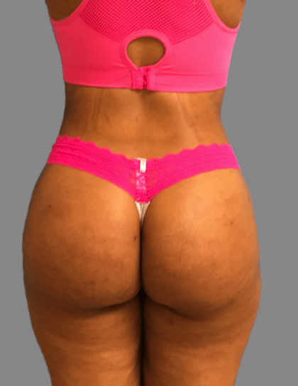 Brazilian Butt Lift Before & After Patient #1444