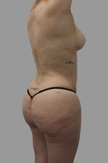 Brazilian Butt Lift Before & After Patient #1447