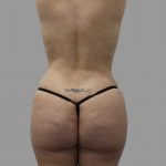 Brazilian Butt Lift Before & After Patient #1447
