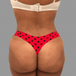 Brazilian Butt Lift Before & After Patient #1456