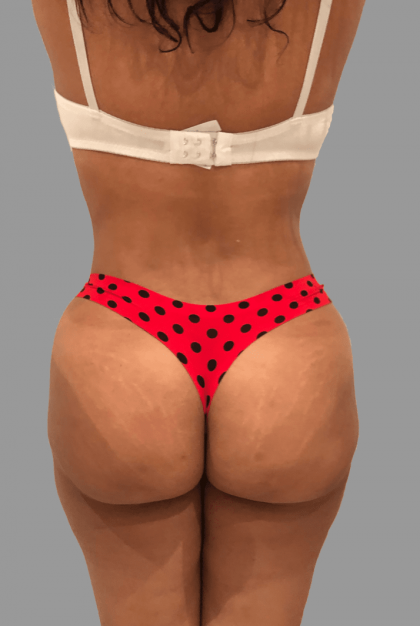 Brazilian Butt Lift Before & After Patient #1456