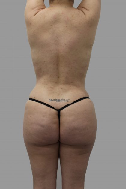 Brazilian Butt Lift Before & After Patient #1447