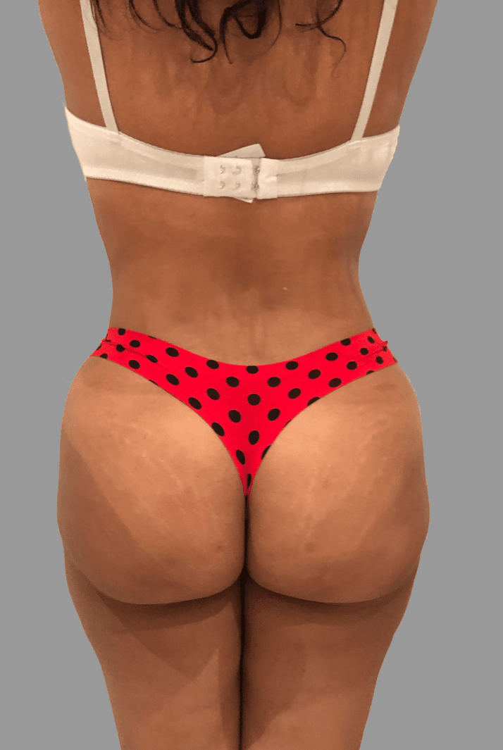 Brazilian Butt Lift Before & After Patient #1456