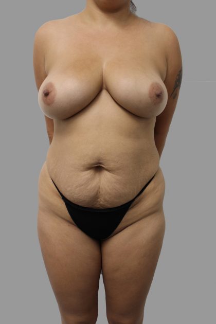 Tummy Tuck Before & After Patient #1577
