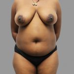 Liposuction Before & After Patient #1682
