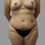 Tummy Tuck Before & After Patient #1691