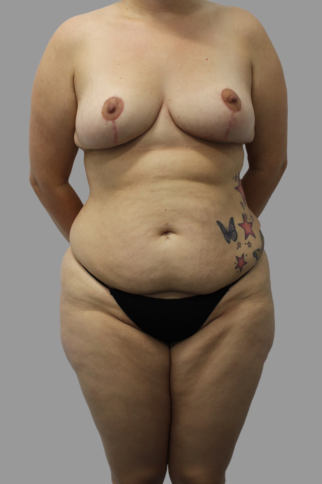 Tummy Tuck Before & After Patient #1691