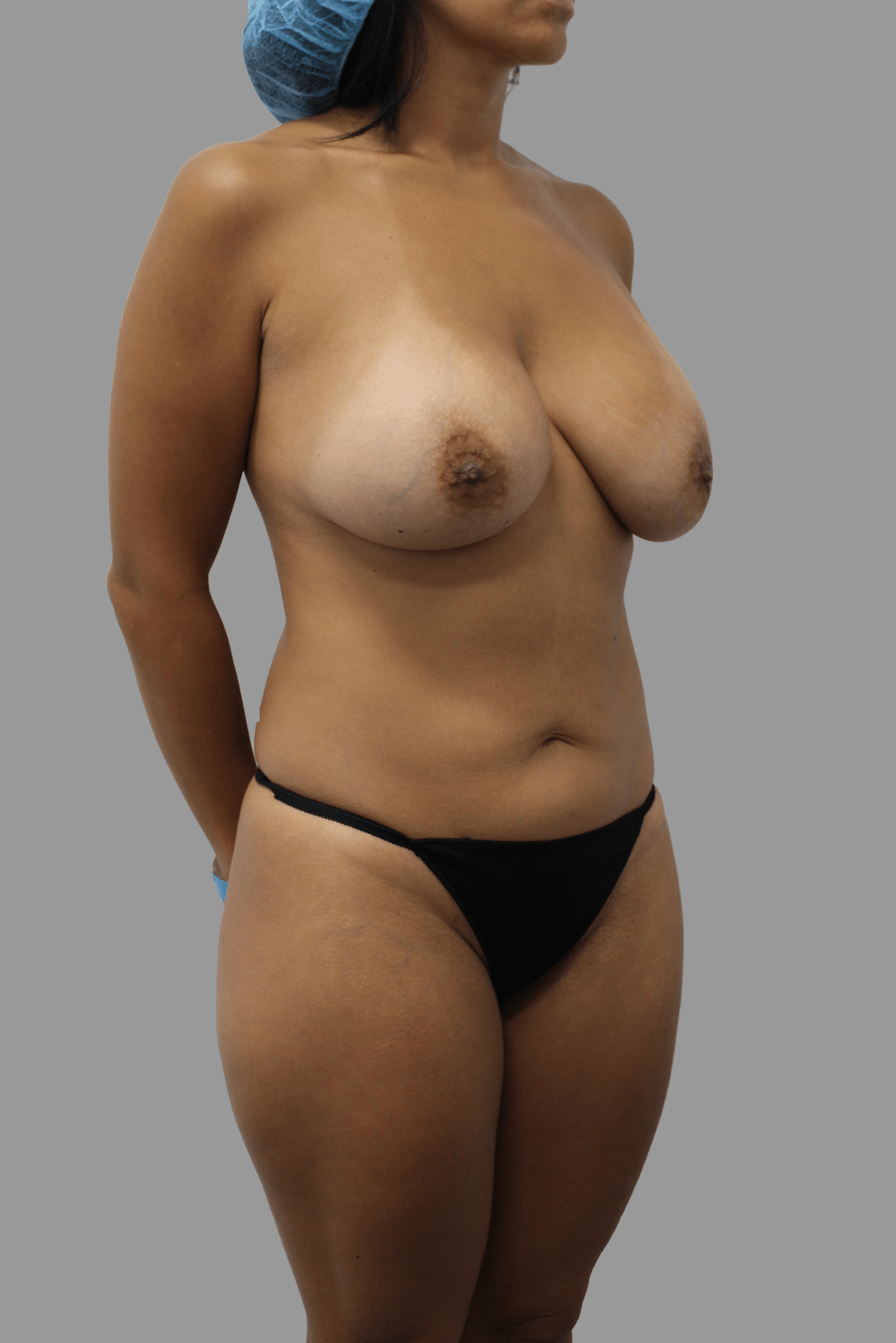 Brazilian Butt Lift Before & After Patient #1679