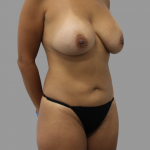 Liposuction Before & After Patient #1688