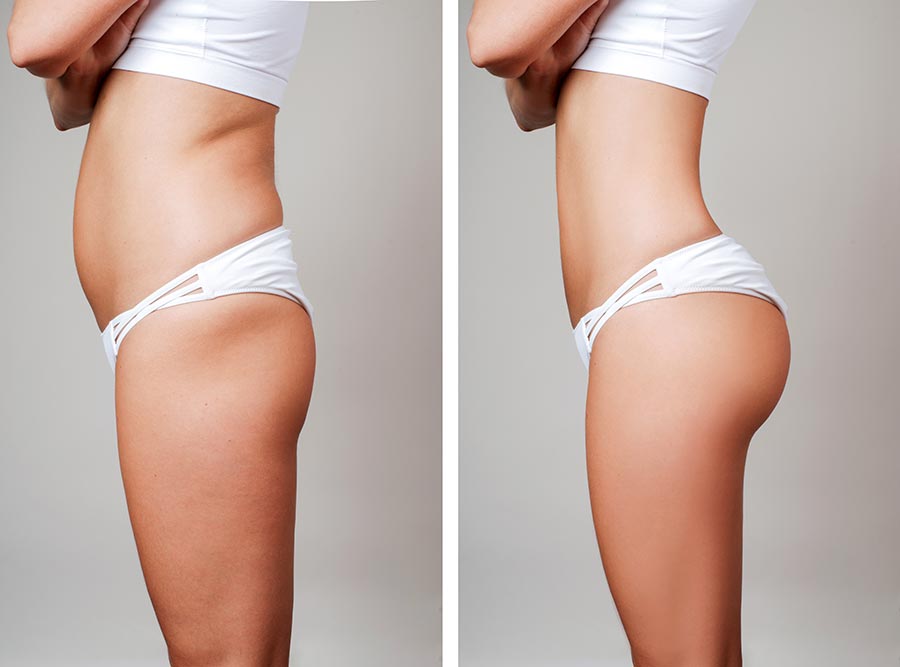 The Best Diet Before & After a Tummy Tuck From Long Island's Most