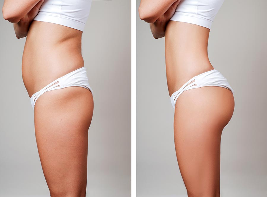 Tummy tuck with lipo on the flanks can create the hourglass shape -  Hourglass Tummy Tuck