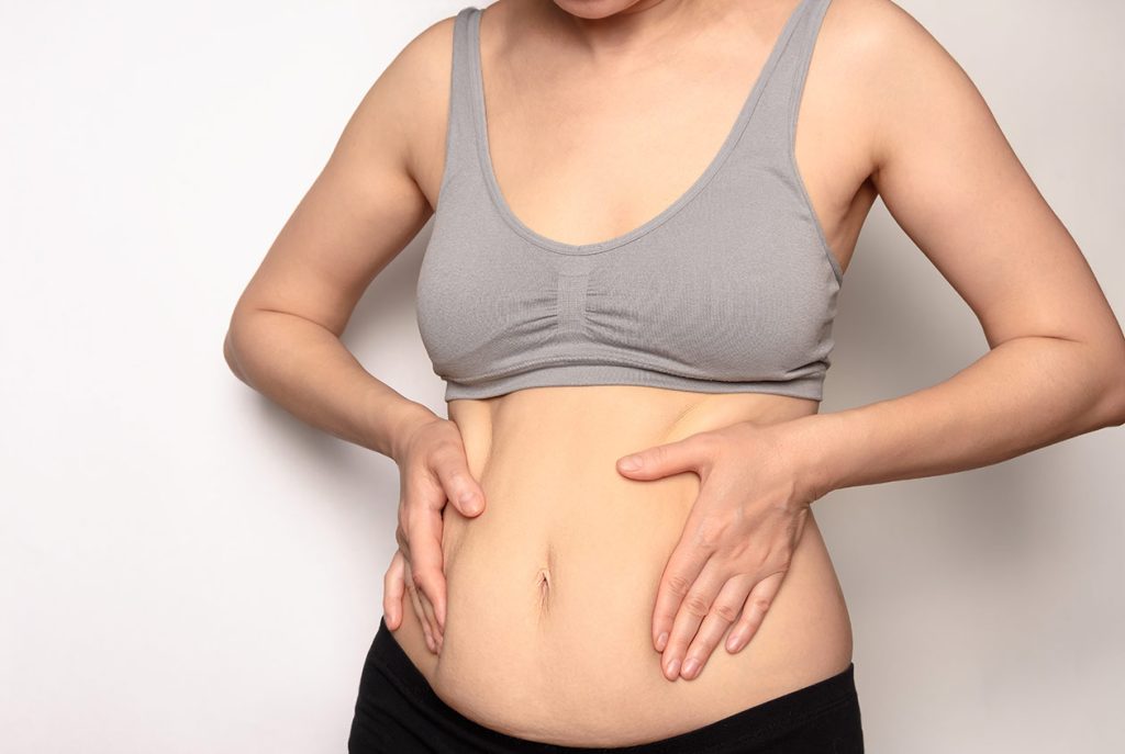 Woman showing how she needs abdominal liposuction. Dr. Gordon Andan New York Surgical Arts.