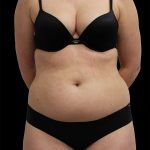 Abdominal Etching Before & After Patient #2397
