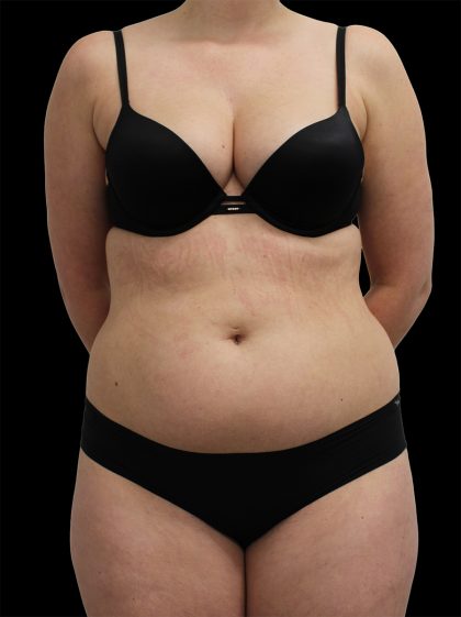 Abdominal Etching Before & After Patient #2397