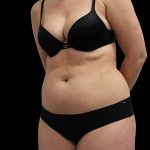 Abdominal Etching Before & After Patient #2397